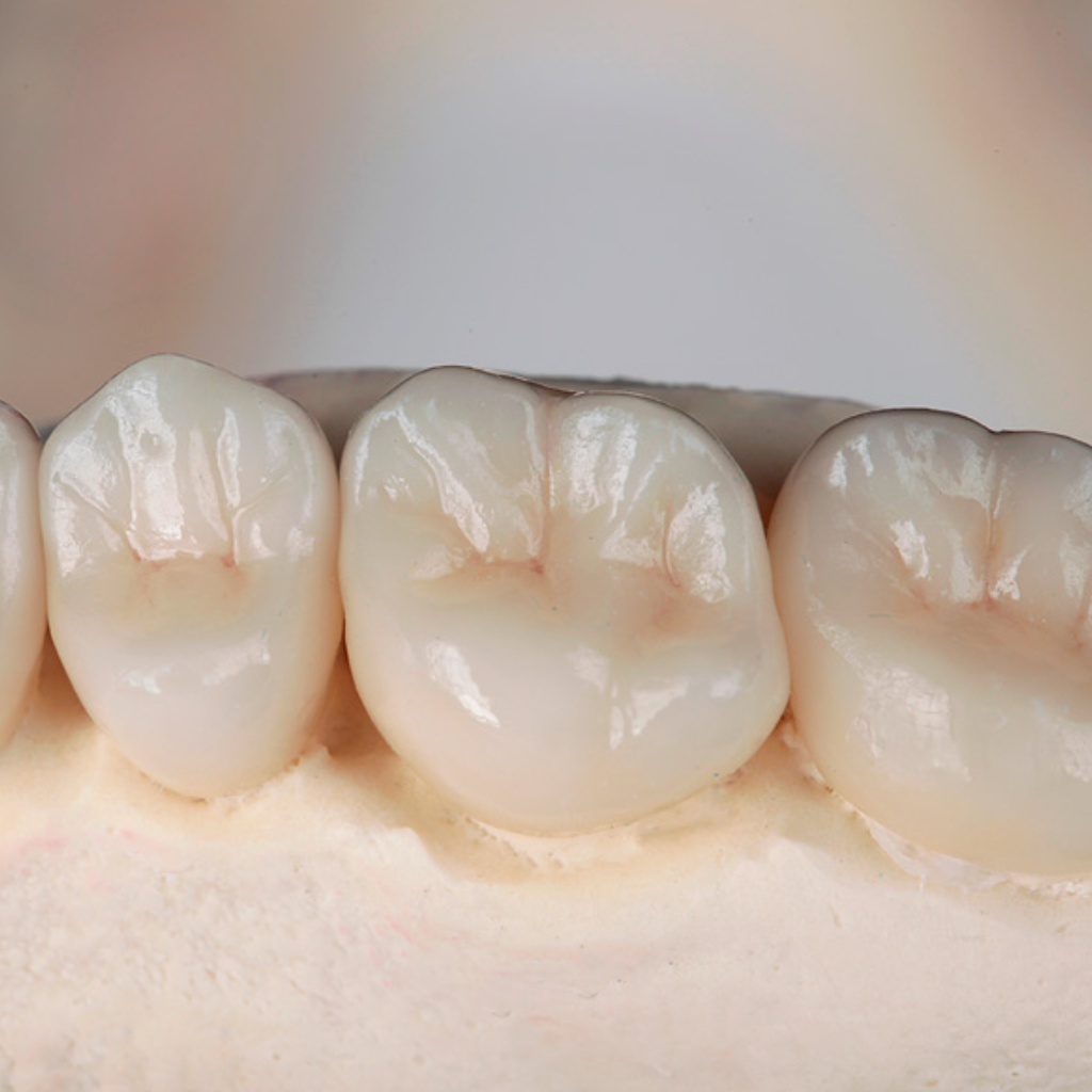 Corona (resina, cerámica o zirconio) desde