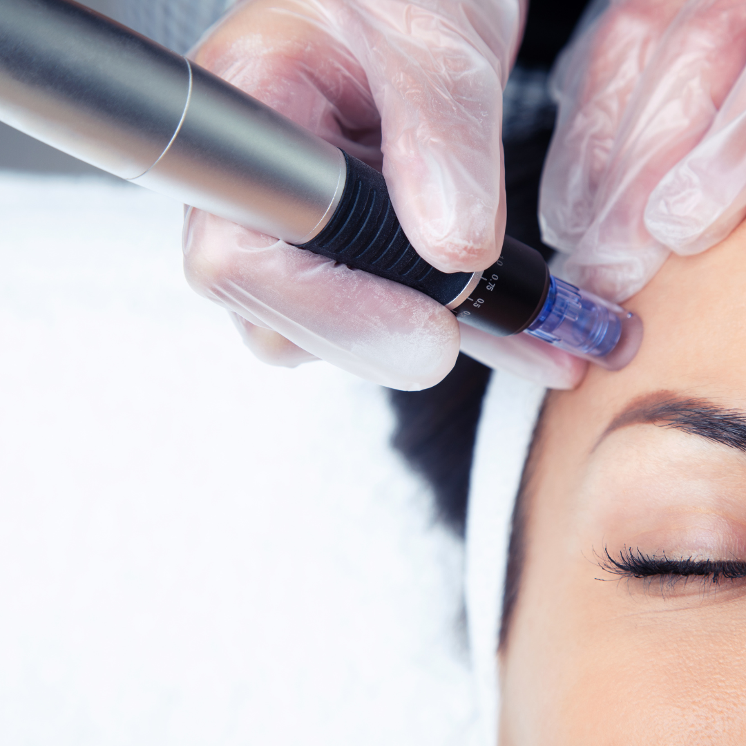 Mesoterapia con Shot Multivitamínico