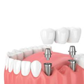 Implantes (previa evaluación)