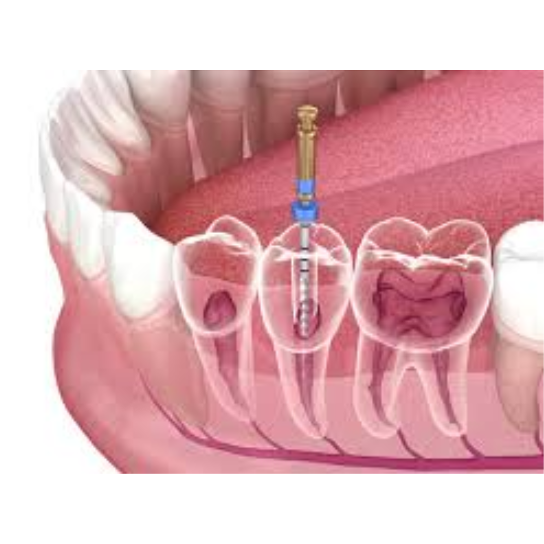 Endodoncia (conducto) - Anterior
