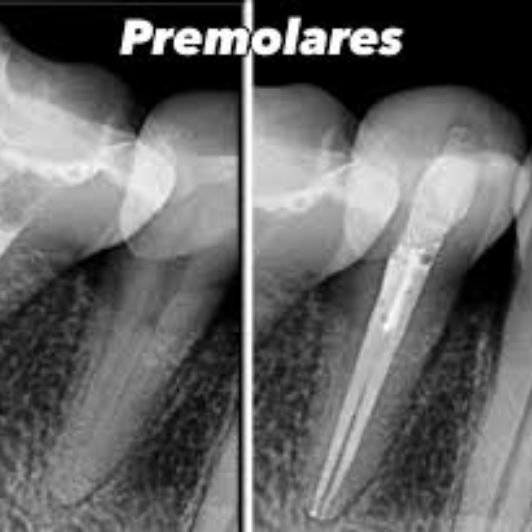 Endodoncia (conducto) - Premolar