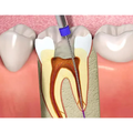 Endodoncia (conducto) - Molar
