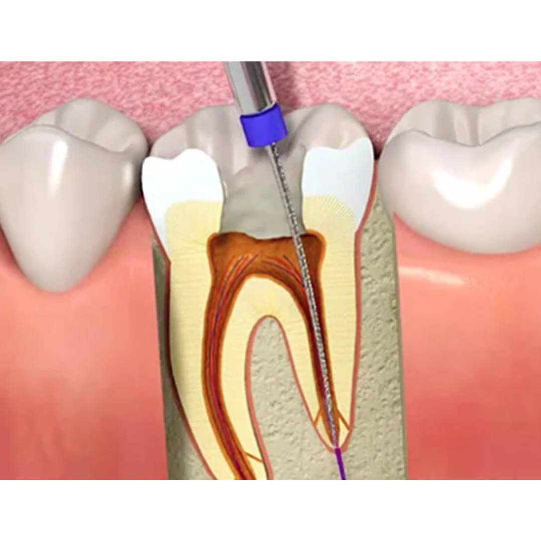 Endodoncia (conducto) - Molar