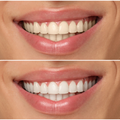 Blanqueamiento dental