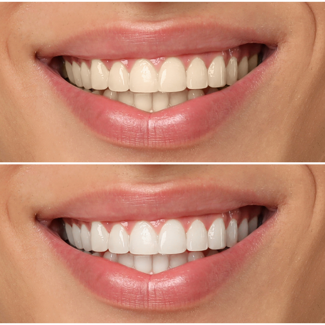 Blanqueamiento dental