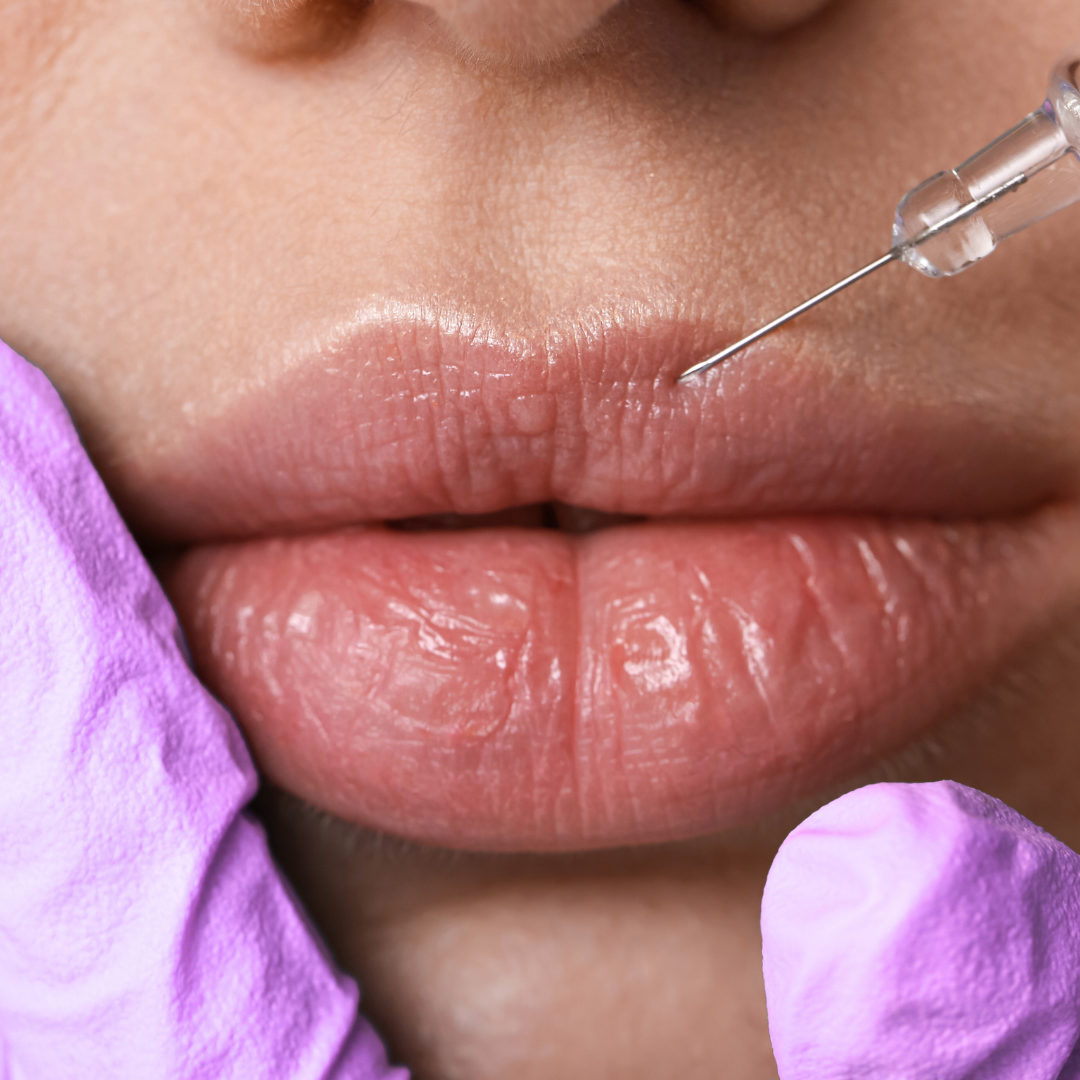 AH Labios (técnica según necesidad)