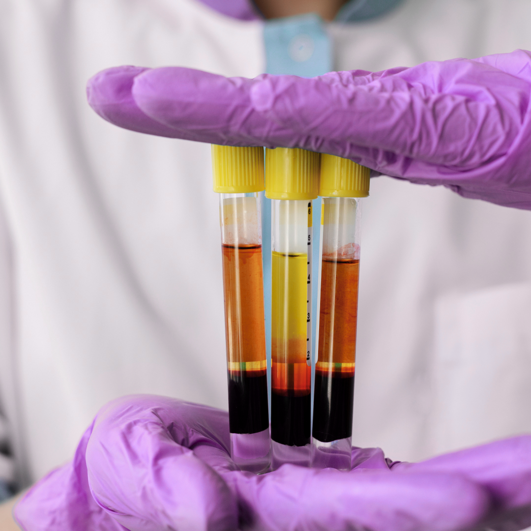 Plasma rico en plaquetas (PRP)