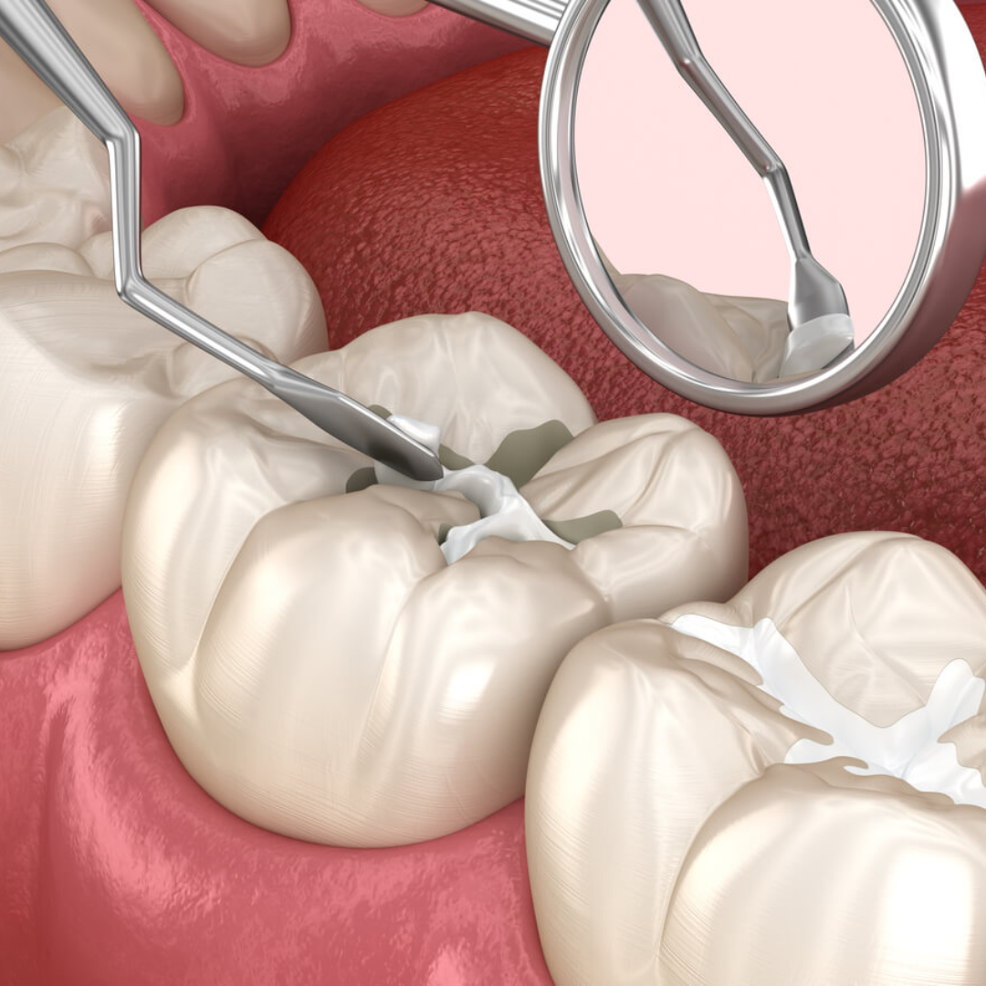 Sellante dental