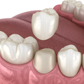 Corona (resina, cerámica o zirconio) desde